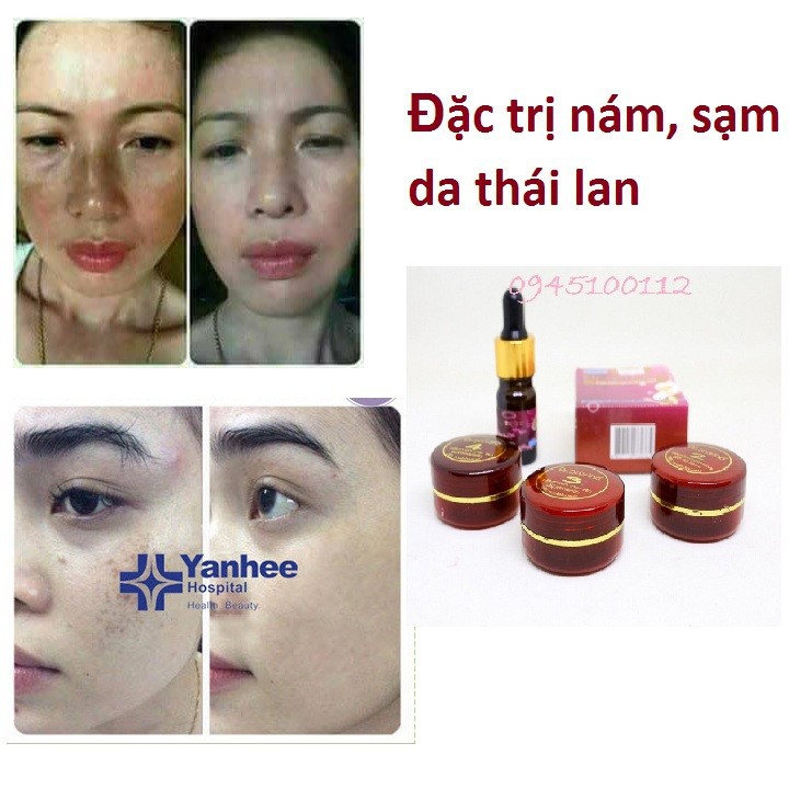 Hình ảnh trước và sau khi sử dụng kem trị nám Yanhee Thái Lan
