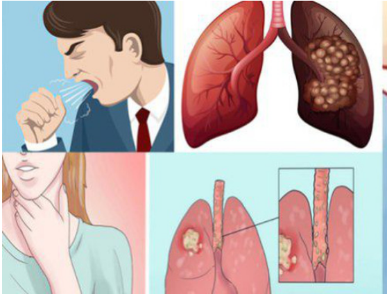 Các dấu hiệu bệnh ung thư phổi