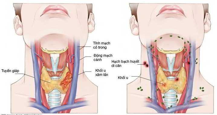 dấu hiệu triệu chứng ung thư vòm họng