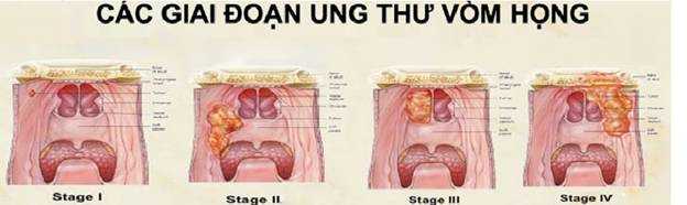 Các giai đoạn của bệnh ung thư vòm họng