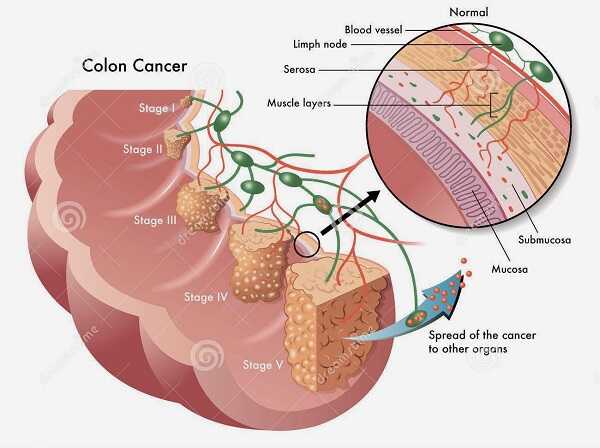 Các giai đoạn của bệnh ung thư trực tràng