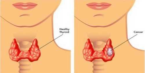 Ung thư vòm họng - Nguyên nhân, dấu hiệu triệu chứng bệnh