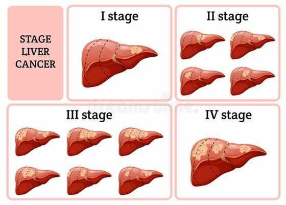Các giai đoạn của ung thư gan và các biểu hiện cần biết